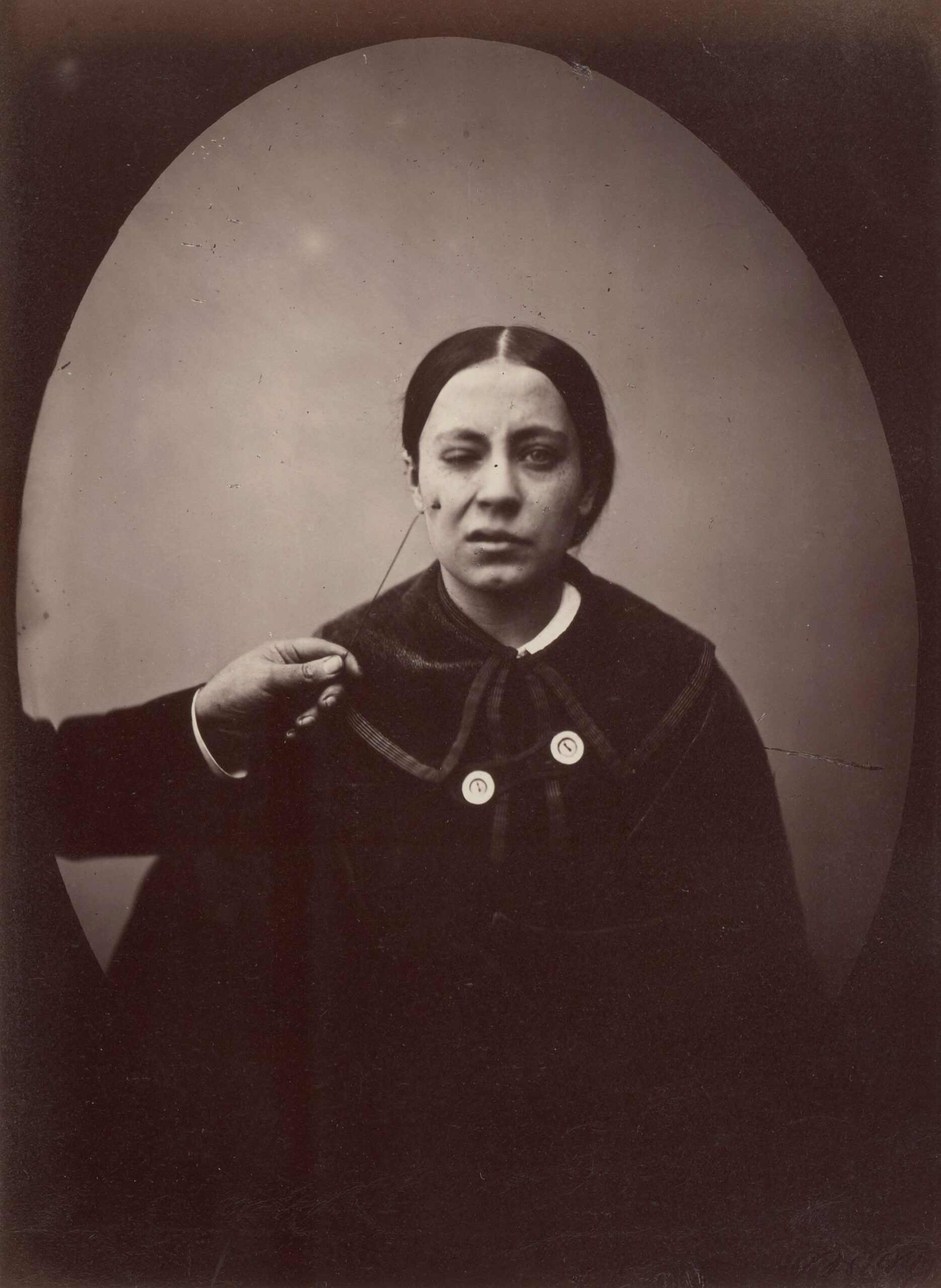 Duchenne de Boulogne and Adrien Tournachon